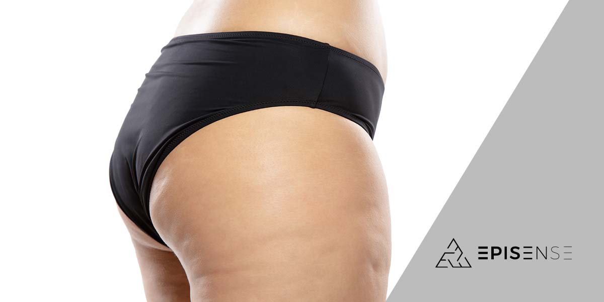 Glúteo de mulher com celulites - site Episense clínica de medicina estética facial e corporal em Matosinhos, Porto - Portugal