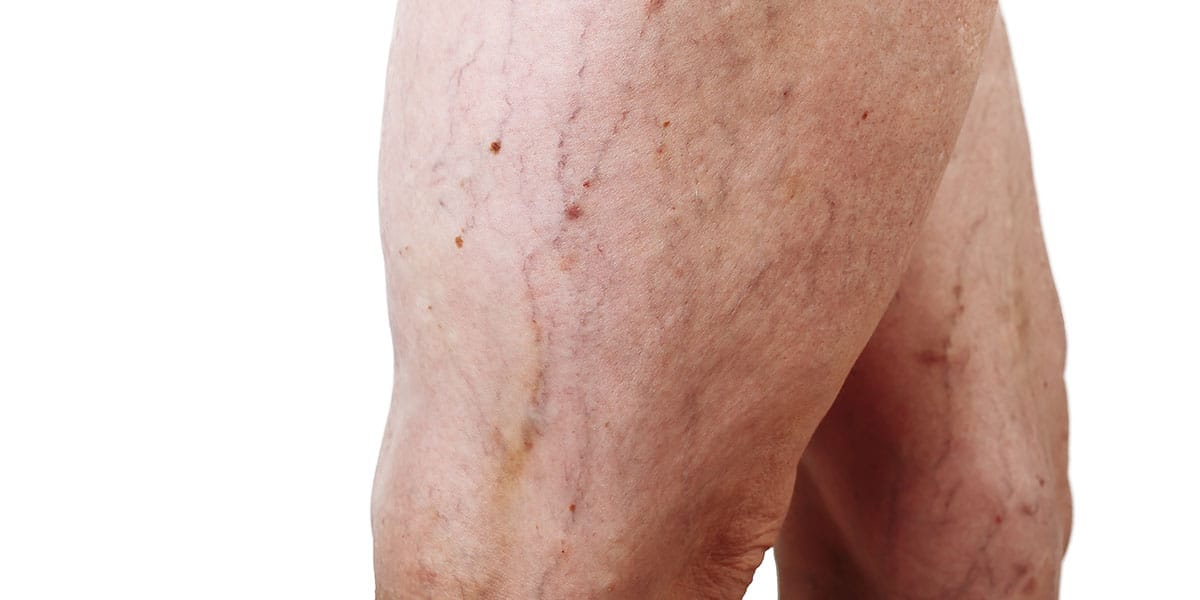 Varizes aparentes na perna - site Episense clínica de medicina estética facial e corporal em Matosinhos, Porto - Portugal