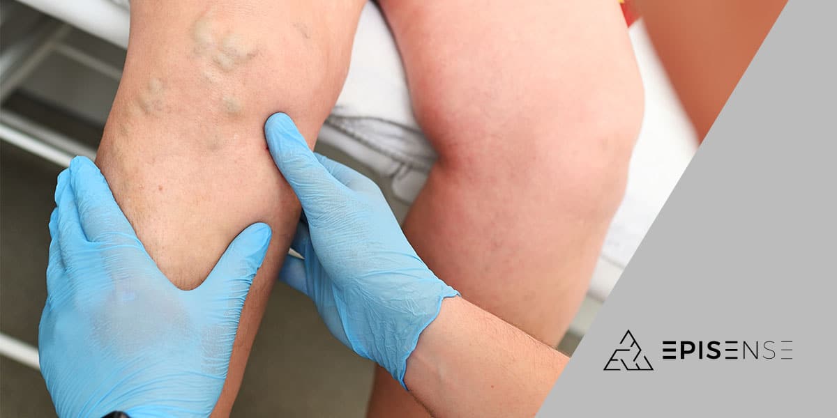 Exame de toque para diagnóstico de varizes - site Episense clínica de medicina estética facial e corporal em Matosinhos, Porto - Portugal