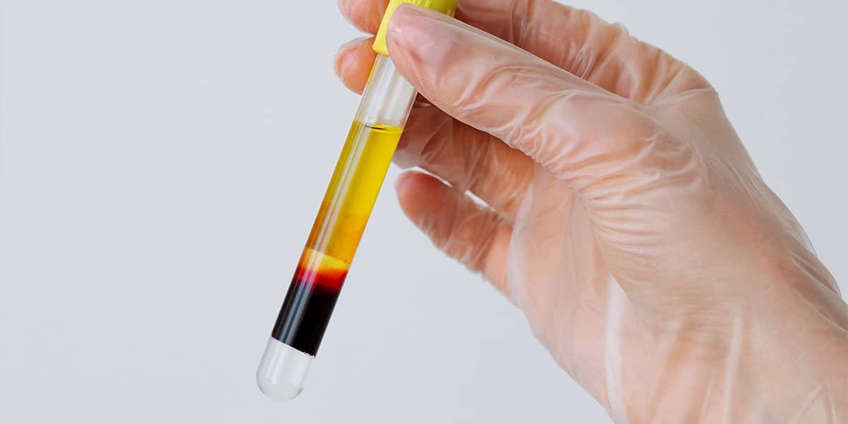 Coleta de exame do paciente - site Episense clínica de medicina estética facial e corporal em Matosinhos, Porto - Portugal